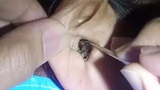 Hearing Loss due to Massive Earwax - Best Earwax Removal