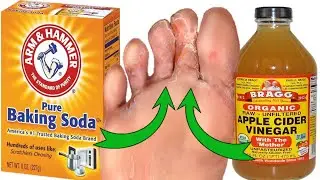 Say Goodbye to Athlete's Foot Naturally: Baking Soda & Apple Cider Vinegar