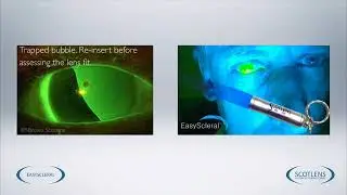Scotlens custom fit contact lenses | EasyScleral Web Fitting Guide