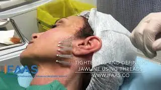 IFAAS Exclusive Technique - Tightening and Defining Jawline Using PDO/PCL Threads