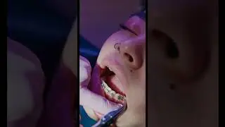 Braces close up 