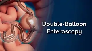 Double-Balloon Enteroscopy | Cincinnati Children's