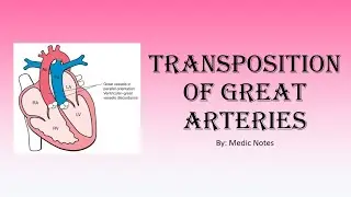 Transposition of great arteries - signs & symptoms, investigation, treatment