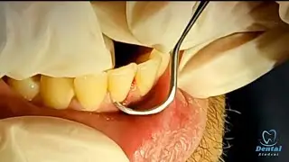 Manual Teeth Scaling _ Demo for dental student