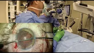 Traumatic Cataract Removal with Traumatic Zonulopathy and Iris Cerclage Repair
