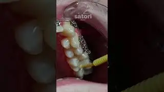 Occlusal overlays for teeth