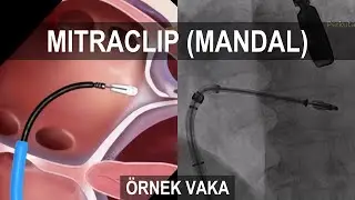 MITRACLIP | Vakalarımızdan Bir Örnek