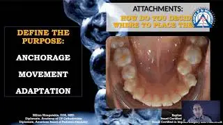 Monday Tip: The Importance of Attachments in Clear Aligner Cases