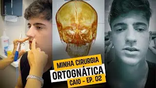 Cirurgia Ortognática - Microssomia Hemifacial - EP. 02