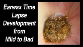 Earwax Time-Lapse Development from Mild to BAD!