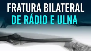 Caso clínico fratura bilateral de rádio e ulna