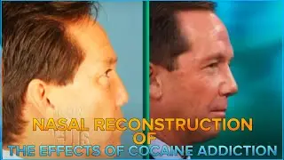 Dr Jay Calvert Revision Rhinoplasty: Nasal Reconstruction of the effects of cocaine addiction