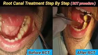 Root Canal Treatment Step BY Step (RCT) | Endodontic Treatment procedure | Endodontic therapy