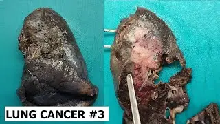 Lung cancer gross #3