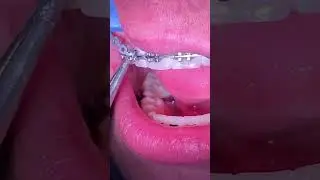 Power Chains Braces - Why Am I Getting Power Chains? Toothtime Family Dentistry New Braunfels