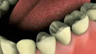 Cerec Inlays and Onlays