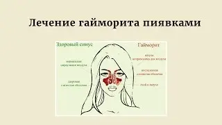 Лечение гайморита с помощью пиявок