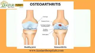 Osteoarthritis Treatment in Hyderabad | Best Hospital for Osteoarthritis in India