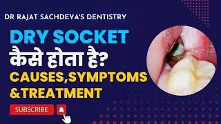 DRY SOCKET TREATMENT |  Dry Socket Wisdom Teeth Symptoms | How To Prevent A Dry Socket