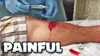 Painful Lacerations (Car Accident), Cysts, Boils & Injuries!