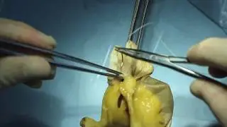 End-to-end intestinal anastomosis technique (part 1: posterior lip)