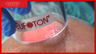 Fotobiostimolazione a luce rossa | Antiaging photobiomodulation | LASEmaR® 800 [Eufoton®]