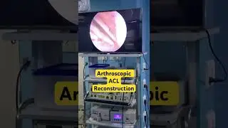 Arthroscopic Anterior cruciate ligament reconstruction #sportsinjury #ligaments #injury #acl #pcl