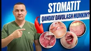 Оғиздаги тошмалар! | Стоматит: Сабаблари ва Даволаш