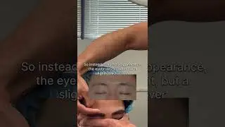 Eyebrow transplant immediately post-op | Anthony Bared MD, FACS | Miami, FL