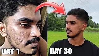 നാല് വർഷം കൊണ്ട് മാറാത്ത മുഖ കുരു ഒറ്റ മാസം കൊണ്ട് മാറ്റിയെടുത്തു🔥, Isotretinoin malayalam 