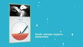 DHI Saç ekim tekniği
