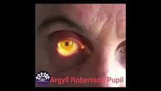 ARGYLL ROBERTSON PUPIL