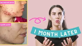 How I Cured My Adult Hormonal Cystic Acne (no accutane or birth control)