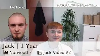 1 Year Hair Loss Treatment & Hair Transplant Result (Jack)