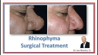 Surgical Treatment of Rhinophyma by Dr. Joe Niamtu, III