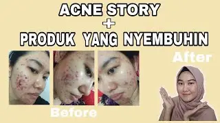 [ ACNE STORY PART III ] SEMBUH DARI JERAWAT TERPARAH SEUMUR HIDUP | PRODUK BISA DI BELI DI APOTIK