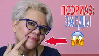ПСОРИАЗ: ЗАЕДЫ (ХЕЙЛИТ)