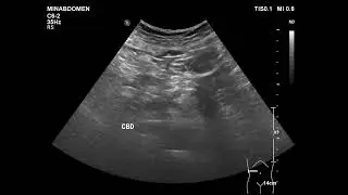 acalculous cholecystitis