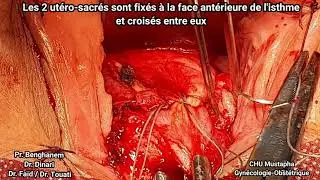 Manchester Fothergill+ Richter Richardson procedure -Pelvic prolapse with cervical elongation-