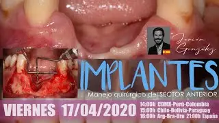 CONVERSATORIO 25 | Manejo quirúrgico del sector anterior con implantes | Jerián González