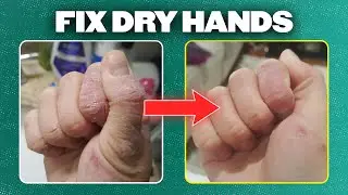 Dermatologist's Guide: How to Prevent and Treat Dry Hands