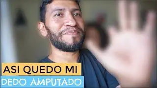 RESULTADO! MI DEDO 
