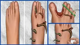 ASMR Removal Leeches from human feet | Removing  worms From Between Toes