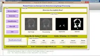 Matlab code for Osterporosis Detection using image processing