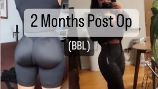 BBL UPDATE: 2 Months Post Op!! | Whitney Lynn |