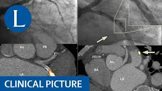 Typing a myocardial infarction using advanced scanning