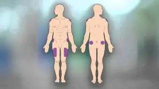 How to Give Yourself an Intramuscular Injection
