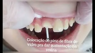 Eu caí e quebrei o dente