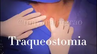 Traqueostomia