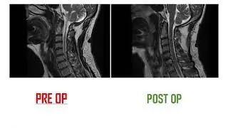 Herniation of intervertebral discs at C5-6 and C6-7 levels of the cervical spine. Patient:M.A yo1968
